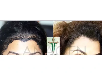 Hair Transplant in Mumbai by Hair Transplant Experts of Mumbai at Best Hair  Tranplant Cost in Mumbai