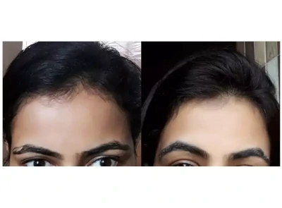 INDIAS NUMBER 1 HAIR TRANSPLANT CENTER BEST RESULTS  CALL 9222222407   YouTube