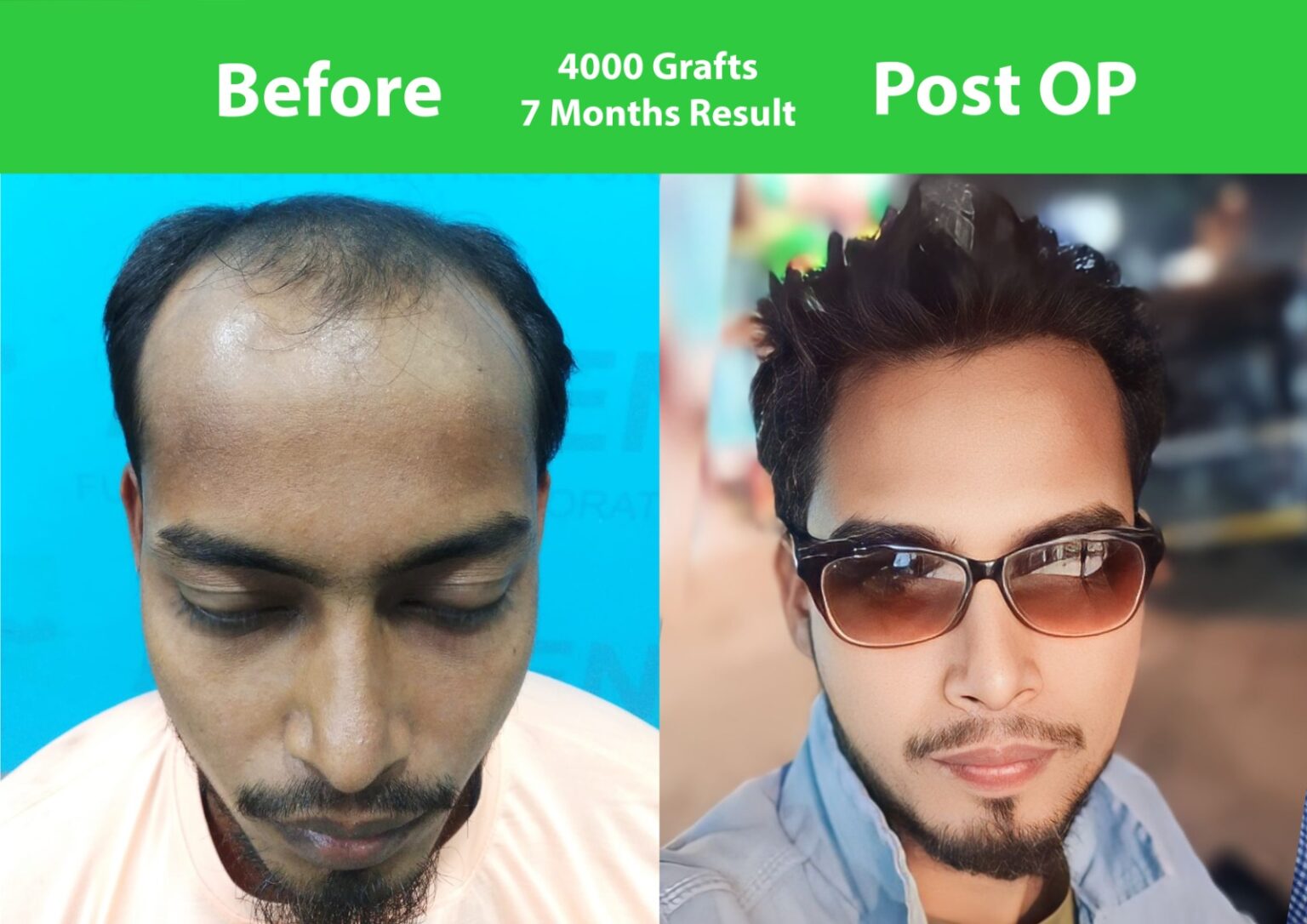 Hair Transplant Result Mumbai Hair Transplant In Mumbai By Hair Transplant Experts Of Mumbai 6294